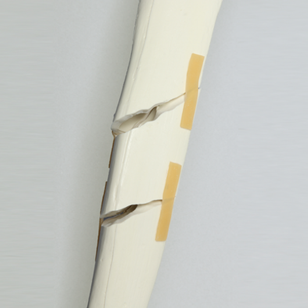 Tibia with Segmental Fracture, Solid Foam, Left, Medium
