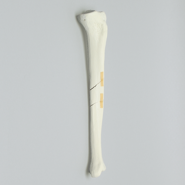 Tibia with Segmental Fracture, Solid Foam, Left, Medium