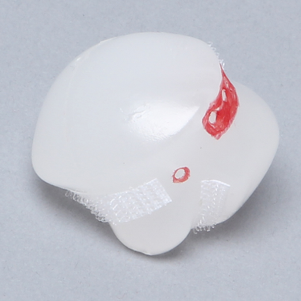 Humeral Head Replacement with Anchor Holes