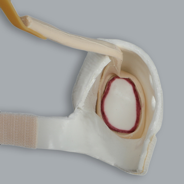 Glenoid Capules Assembly for 1509 Shoulder Series