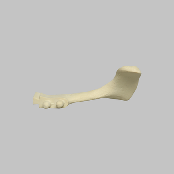 Acromion Replacement for 1509 Shoulders