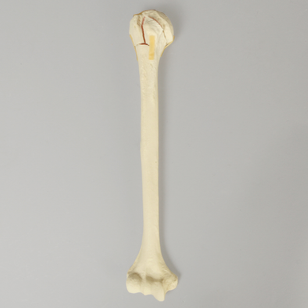 Humerus with Four-Part Bicipital Groove Fracture, Foam Cortical, Right