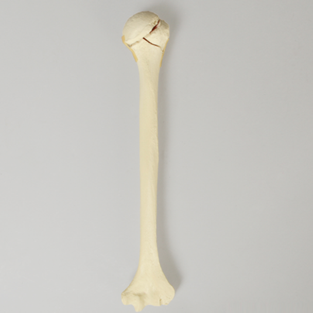 Humerus with Four-Part Bicipital Groove Fracture, Foam Cortical, Right