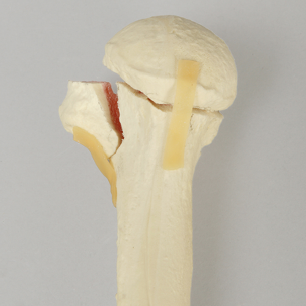 Humerus with Four-Part Bicipital Groove Fracture, Foam Cortical, Right