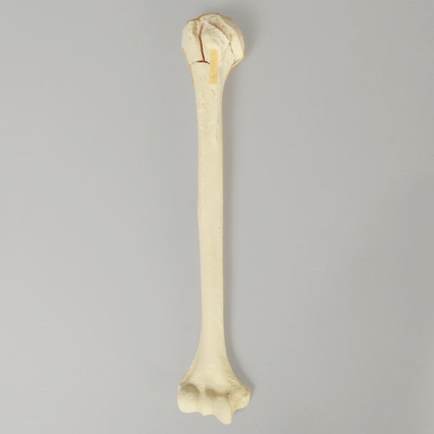 Humerus with Four-Part Bicipital Groove Fracture, Foam Cortical, Right