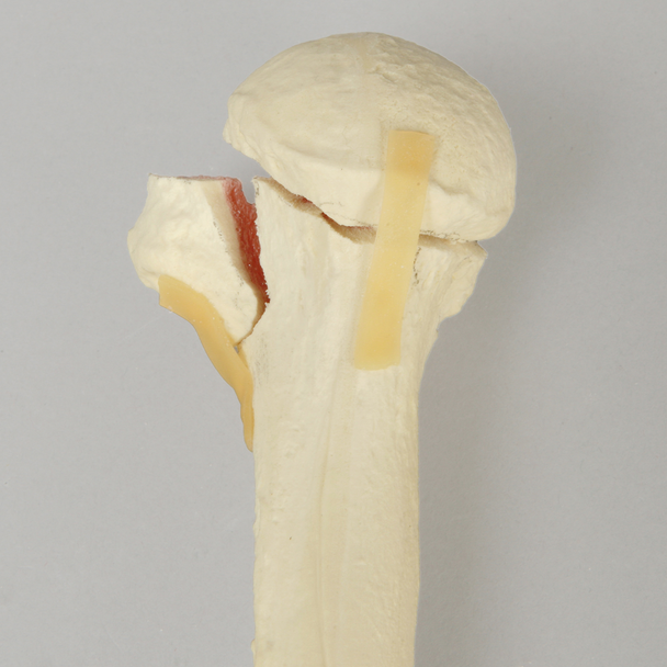 Humerus with Four-Part Bicipital Groove Fracture, Foam Cortical, Right