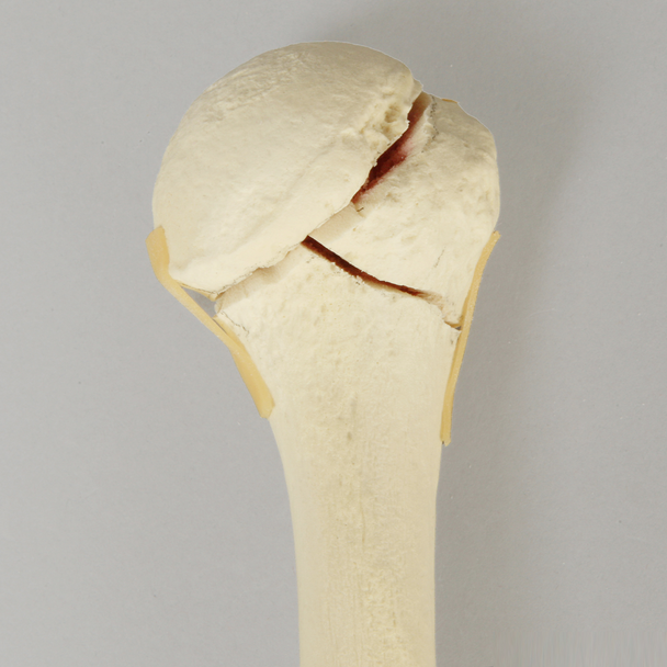 Humerus with Four-Part Bicipital Groove Fracture, Foam Cortical, Right