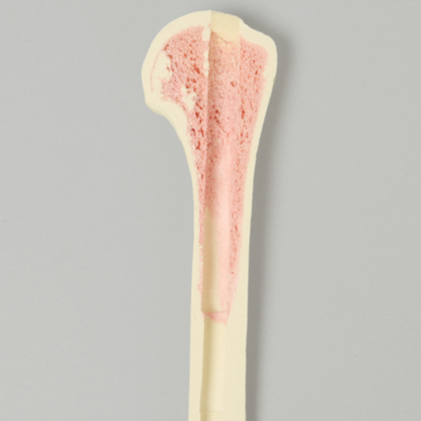 Humerus with 12 mm Proximal Canal, Foam Cortical