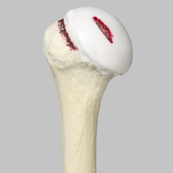Humerus Replacement with Hill-Sachs Lesion