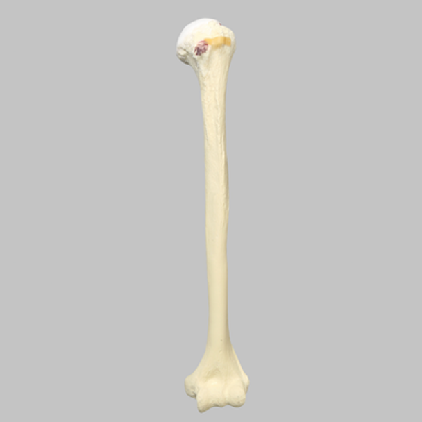 Humerus Replacement with Hill-Sachs Lesion