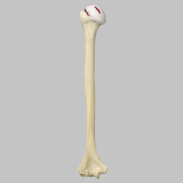 Humerus Replacement with Hill-Sachs Lesion