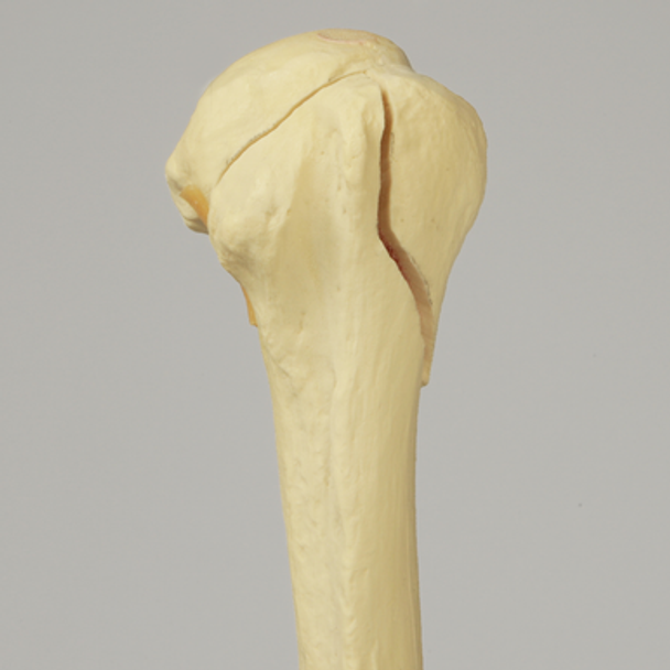 Humerus with Three-Part Head Fracture, Foam Cortical