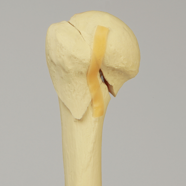 Humerus with Three-Part Head Fracture, Foam Cortical