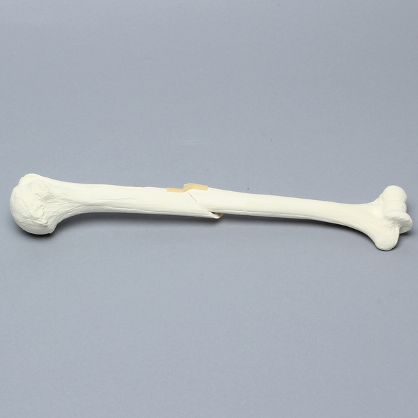 Humerus with Oblique Fracture, Foam Cortical