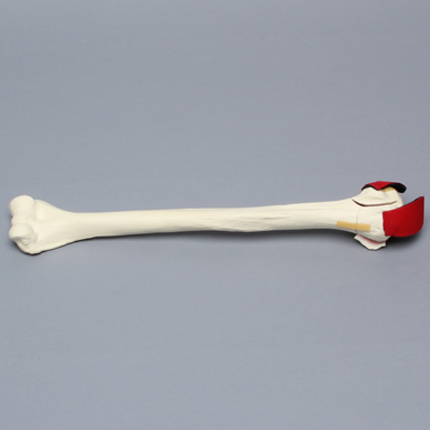 Humerus with Five-Part Head Fracture and Ligaments, Foam Cortical