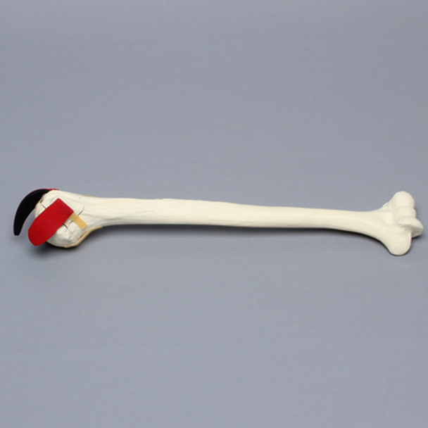 Humerus with Five-Part Head Fracture and Ligaments, Foam Cortical