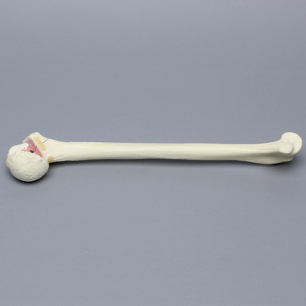 Humerus with Four-Part Bicipital Groove Fracture, Foam Cortical, Left