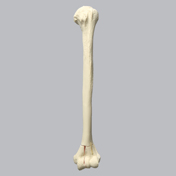 Humerus with Distal "T" Fracture, Foam Cortical