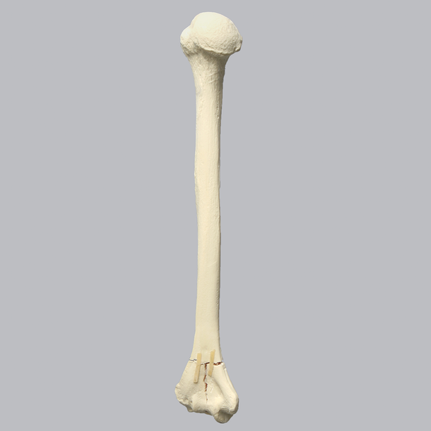Humerus with Distal "T" Fracture, Foam Cortical