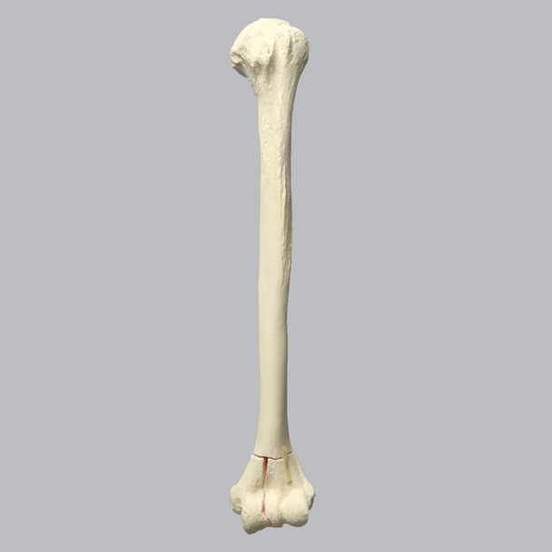 Humerus with Distal "T" Fracture, Foam Cortical