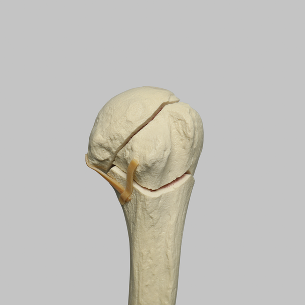 Humerus with Four-Part Head Fracture, Foam Cortical