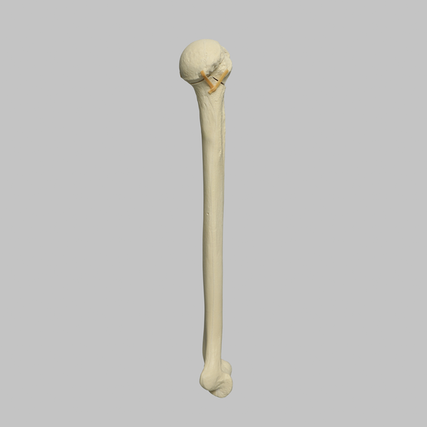 Humerus with Four-Part Head Fracture, Foam Cortical
