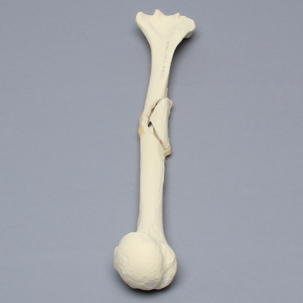 Humerus with Butterfly Fracture, Foam Cortical