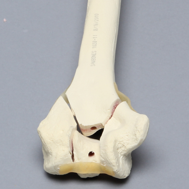 Humerus with "Y" Fracture, Foam Cortical