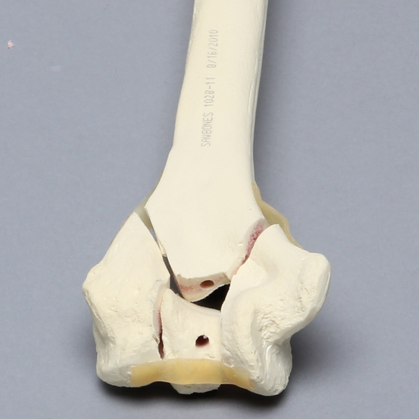 Humerus with "Y" Fracture, Foam Cortical