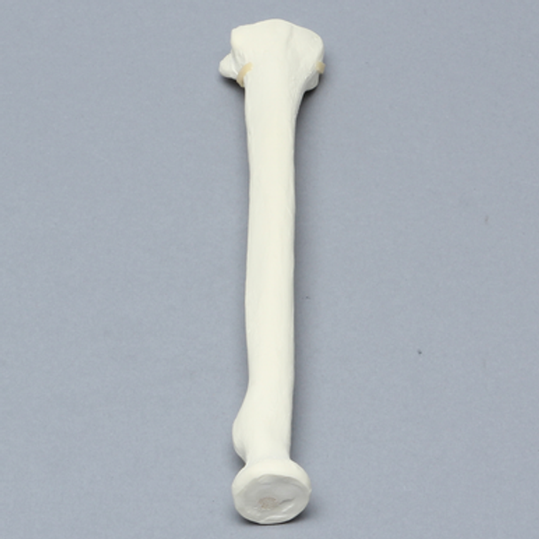 Radius with Fracture for Volar Plate, Foam Cortical