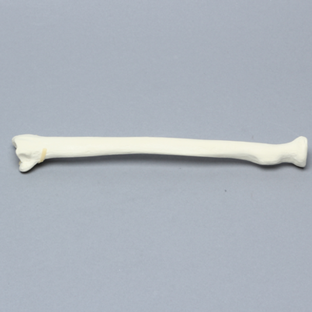 Radius with Fracture for Volar Plate, Foam Cortical