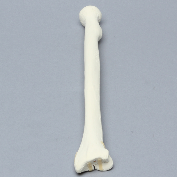 Radius with Fracture for Volar Plate, Foam Cortical