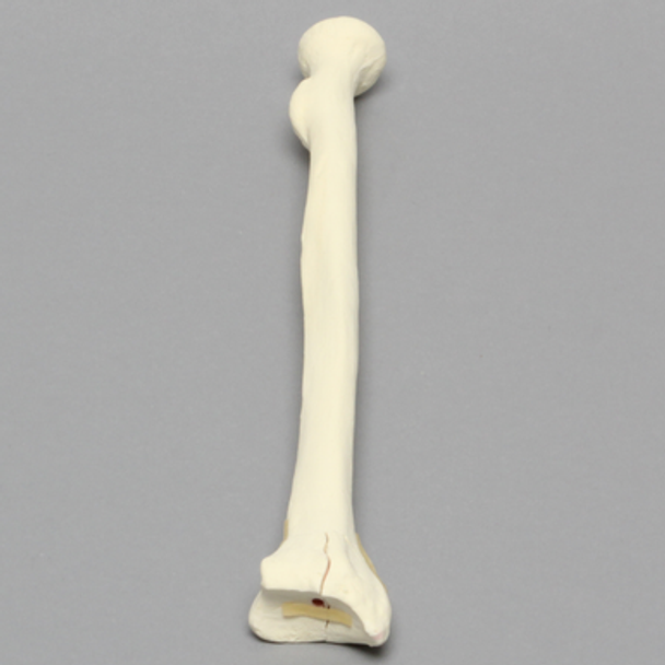 Radius with Three-Part Intra-Articular Fracture, Foam Cortical, Right