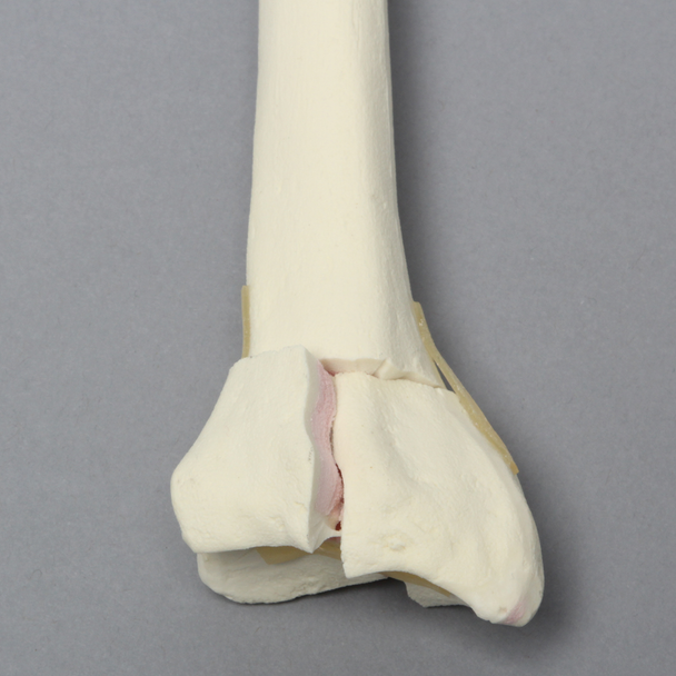 Radius with Three-Part Intra-Articular Fracture, Foam Cortical, Right