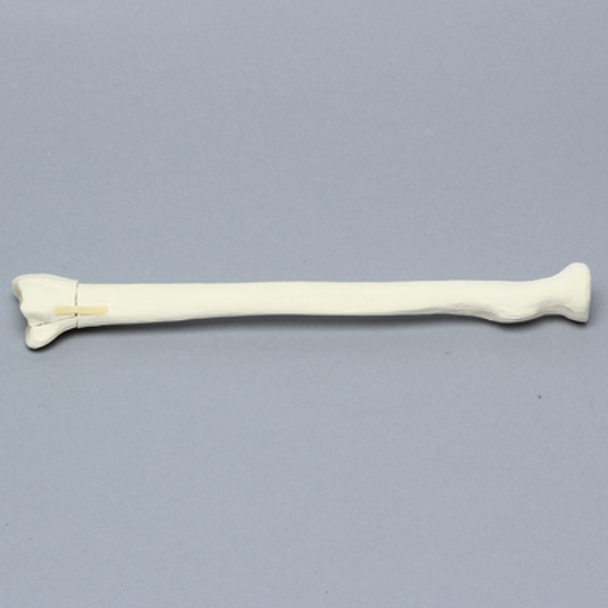 Radius with Four-Part Fracture, Foam Cortical