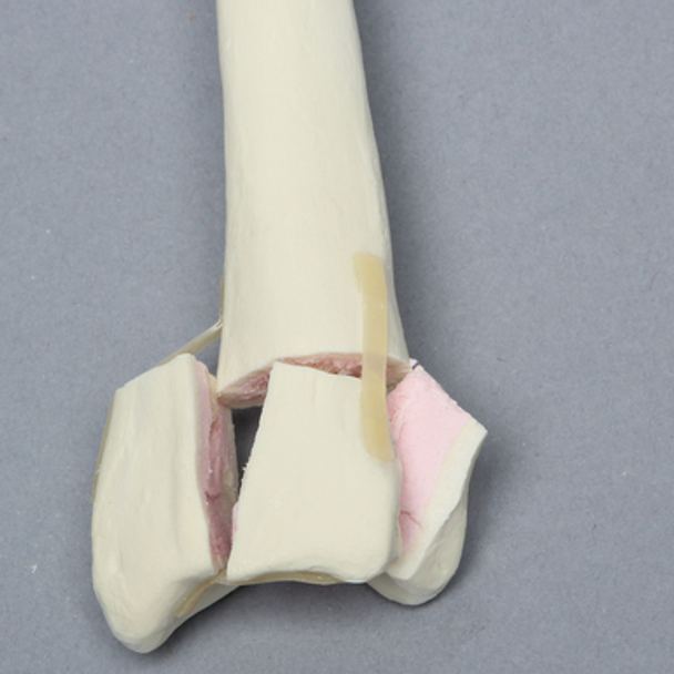 Radius with Four-Part Fracture, Foam Cortical