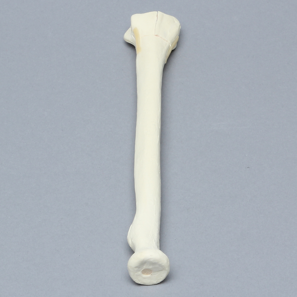 Radius with Four-Part Fracture, Foam Cortical
