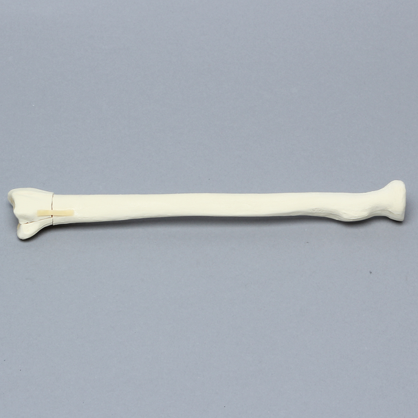 Radius with Four-Part Fracture, Foam Cortical