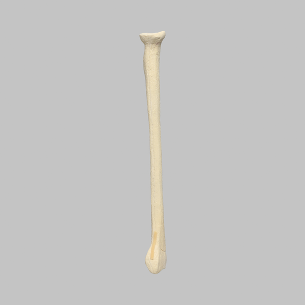 Radius with Three-Part Intra-Articular Fracture and Removed Tubercle, Foam Cortical