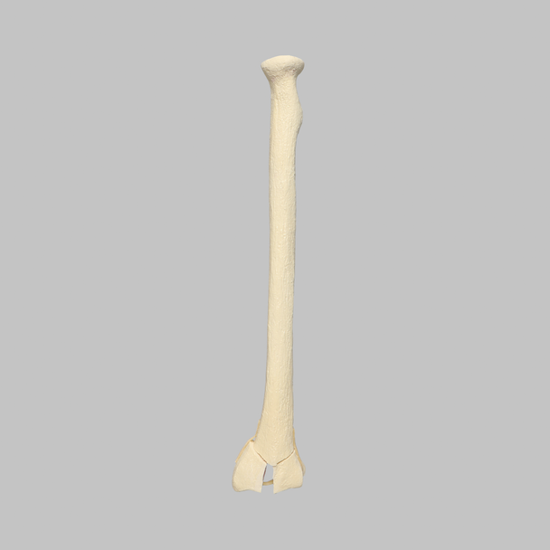 Radius with Three-Part Intra-Articular Fracture and Removed Tubercle, Foam Cortical
