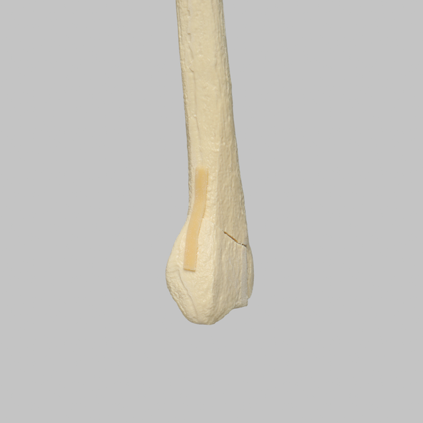 Radius with Three-Part Intra-Articular Fracture and Removed Tubercle, Foam Cortical