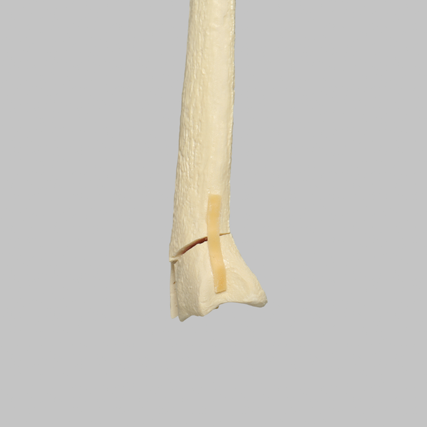 Radius with Three-Part Intra-Articular Fracture and Removed Tubercle, Foam Cortical