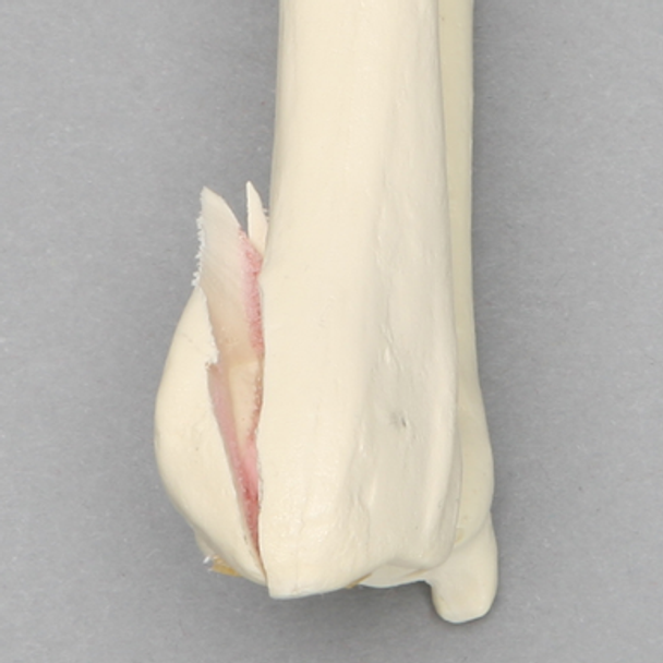 Ulna and Radius with Volar Fracture, Foam Cortical