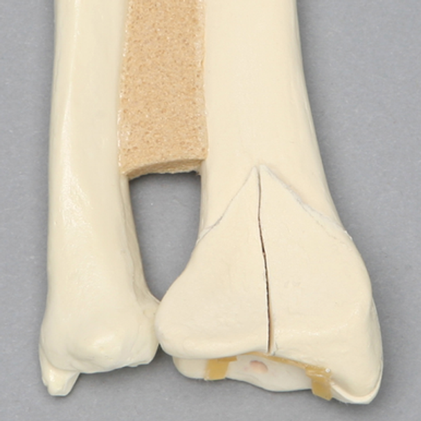 Ulna and Radius with Volar Fracture, Foam Cortical