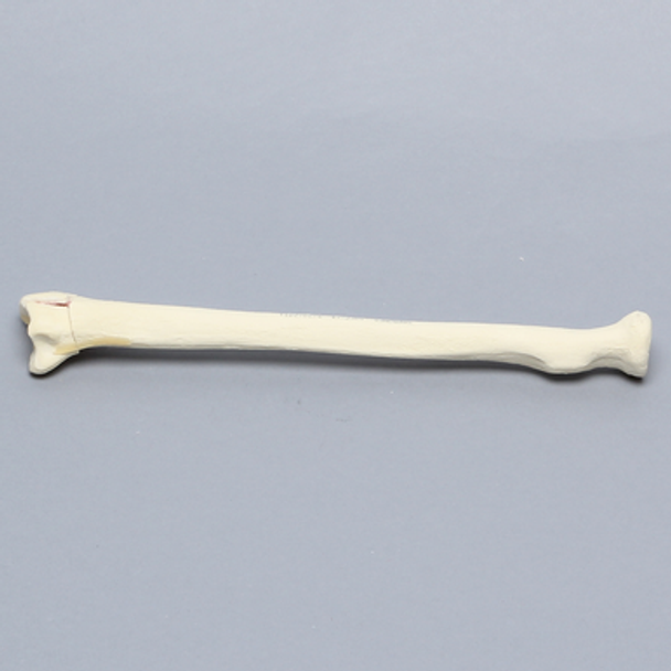 Radius with Three-Part Intra-articular Fracture, Foam Cortical