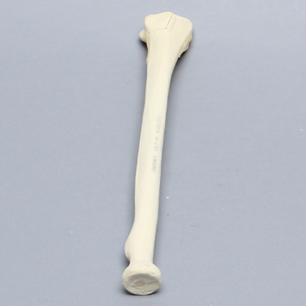 Radius with Three-Part Intra-articular Fracture, Foam Cortical