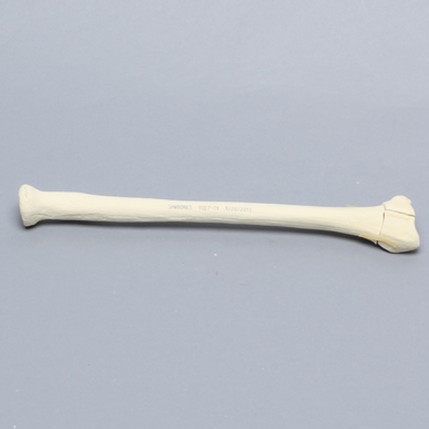 Radius with Three-Part Intra-articular Fracture, Foam Cortical
