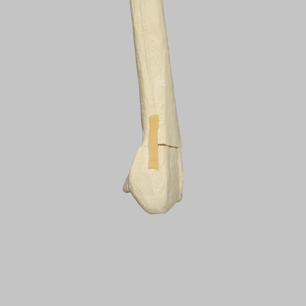 Radius with Three-Part Intra-articular Fracture, Foam Cortical