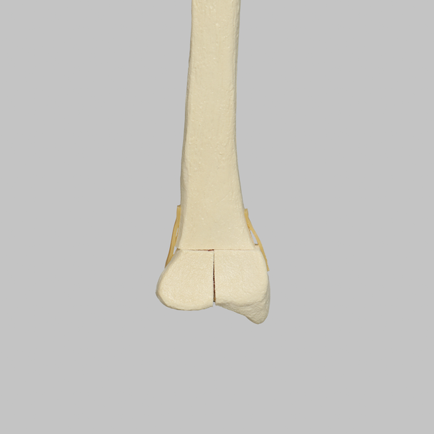 Radius with Three-Part Intra-articular Fracture, Foam Cortical