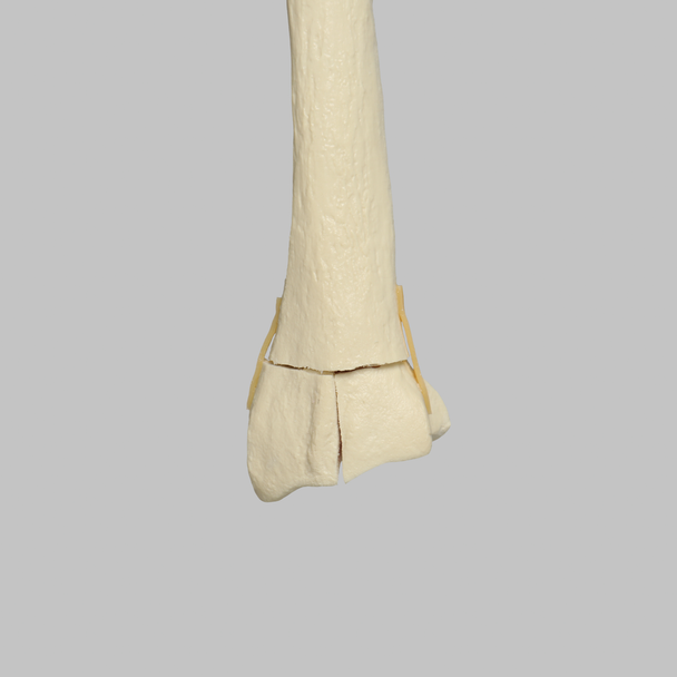 Radius with Three-Part Intra-articular Fracture, Foam Cortical